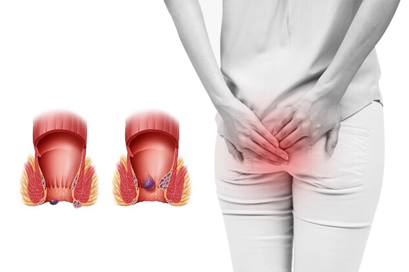bị trĩ sau sinh có hết không