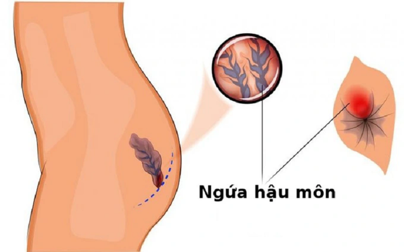 nhiễm nấm hậu môn