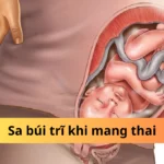 sa búi trĩ khi mang thai