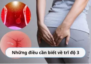 trĩ độ 3