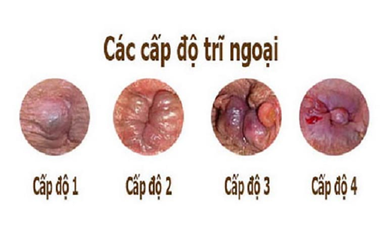 trĩ độ 3