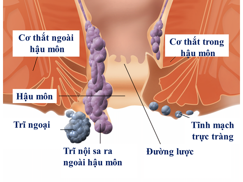trĩ độ 4