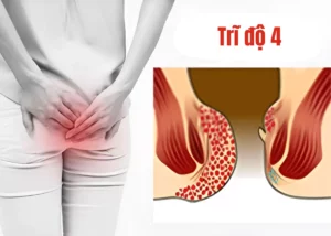 trĩ độ 4