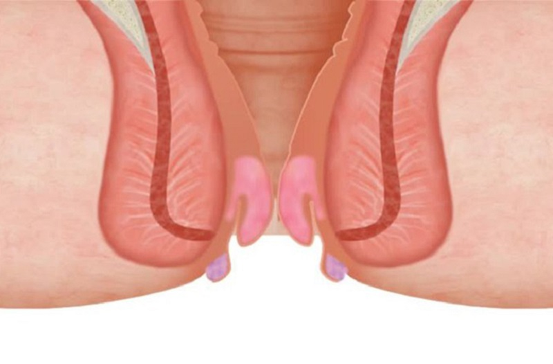 trĩ độ 3