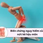 biến chứng của nứt kẽ hậu môn