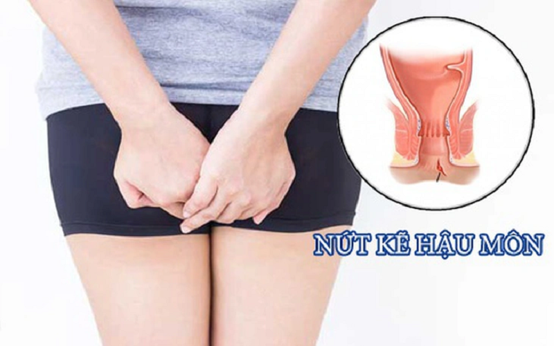 biến chứng của nứt kẽ hậu môn