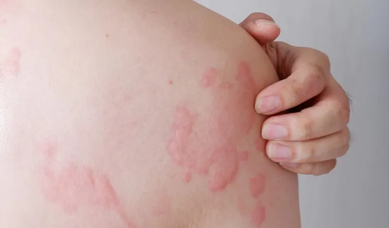 cây cỏ sữa chữa dạ dày
