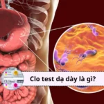 clo test dạ dày là gì