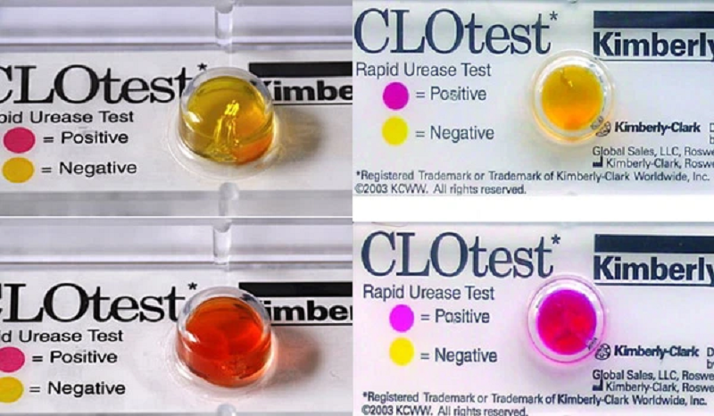 clo test dạ dày là gì