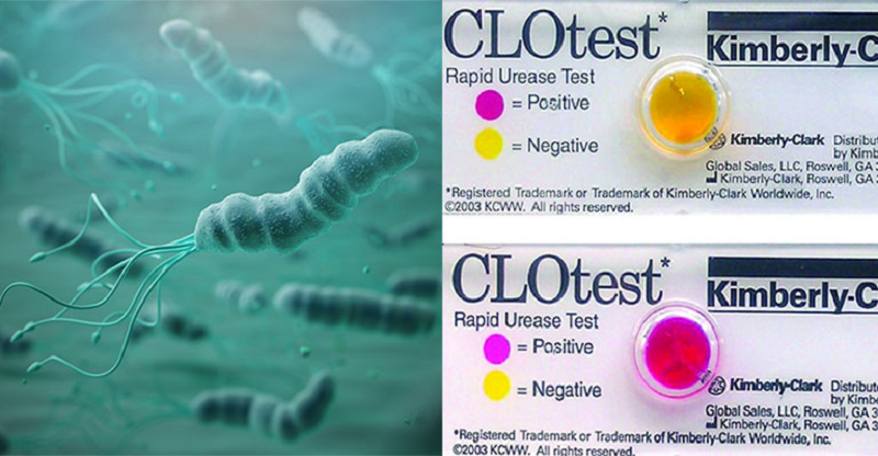 clo test dạ dày là gì