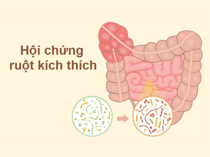 hội chứng ruột kích thích bao lâu thì khỏi