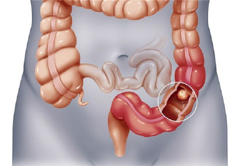 hội chứng ruột kích thích gây sút cân