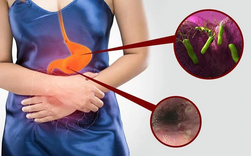 loạn sản dạ dày là gì