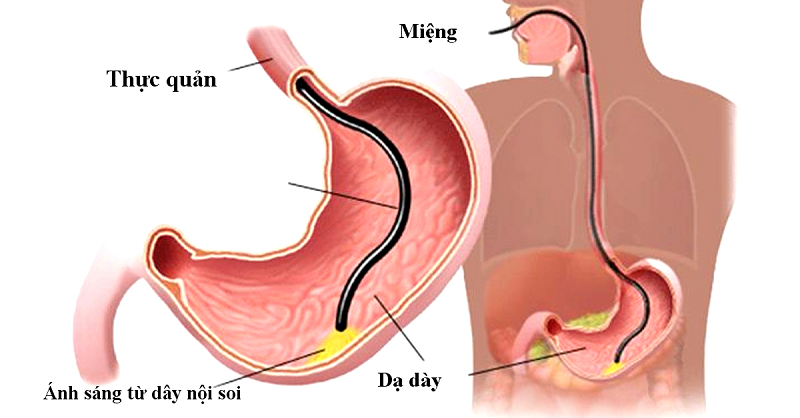 loạn sản dạ dày là gì