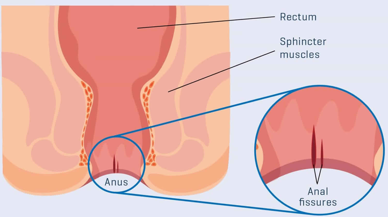 nứt kẽ hậu môn cấp
