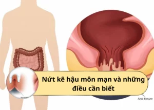 nứt kẽ hậu môn mạn