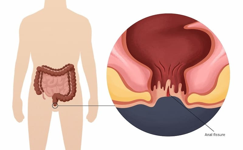 nứt kẽ hậu môn mạn