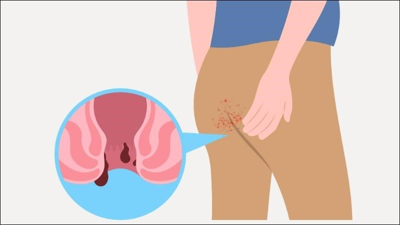 nứt kẽ hậu môn mạn