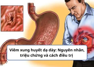 Viêm xung huyết dạ dày