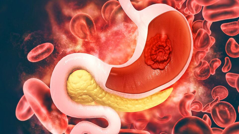 bị sụt cân khi đau dạ dày