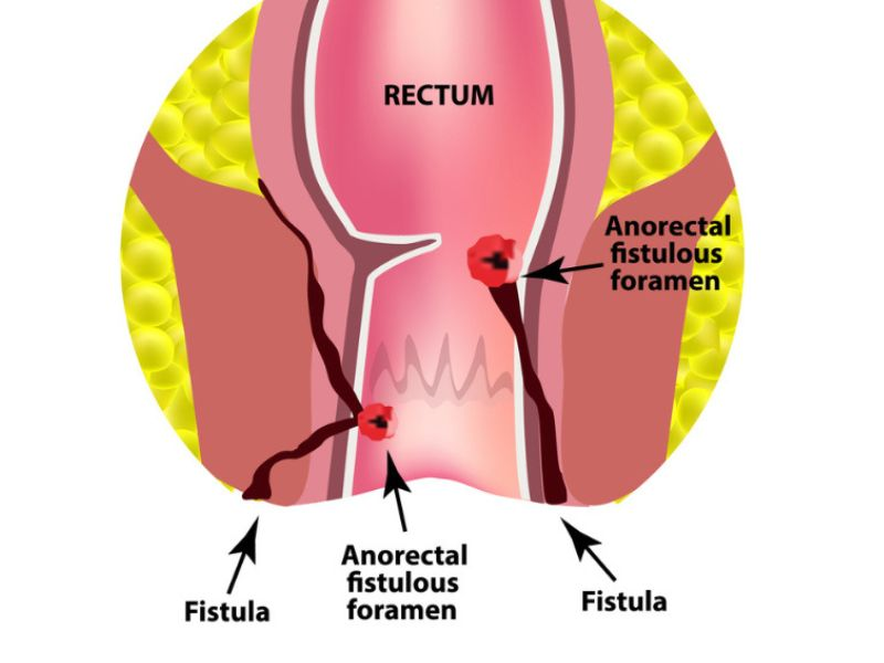 dấu hiệu rò hậu môn tái phát