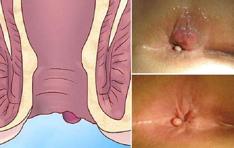 Đi cầu ra máu tươi