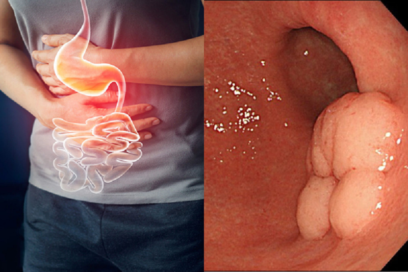 giảm đau dạ dày sau khi uống rượu