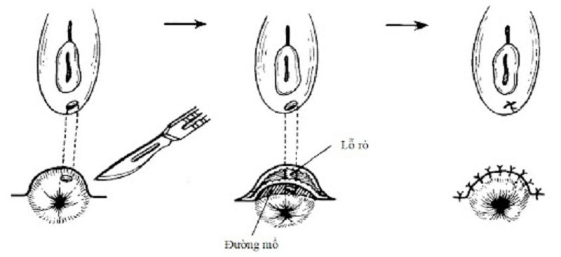 hậu môn tiền đình là gì