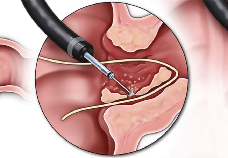hậu môn tiền đình là gì