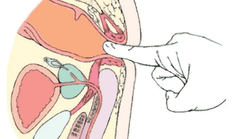 hẹp hậu môn sau mổ trĩ