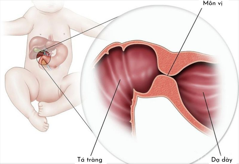 Hẹp môn vị là gì