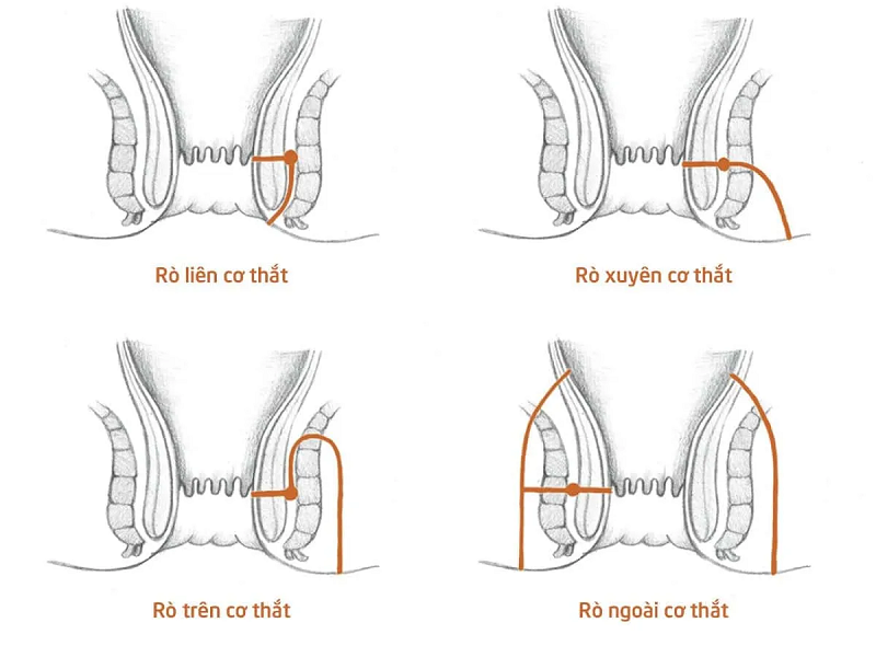 rò hậu môn gian cơ thắt là gì