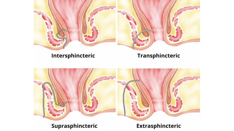 rò hậu môn xuyên cơ thắt