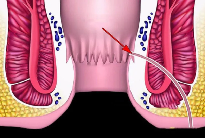 rò hậu môn xuyên cơ thắt
