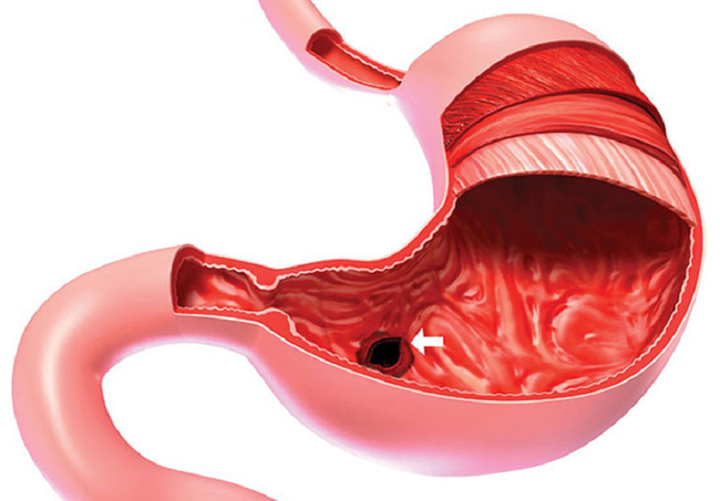 Viêm xung huyết dạ dày