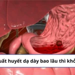 xuất huyết dạ dày bao lâu thì khỏi