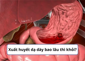 xuất huyết dạ dày bao lâu thì khỏi