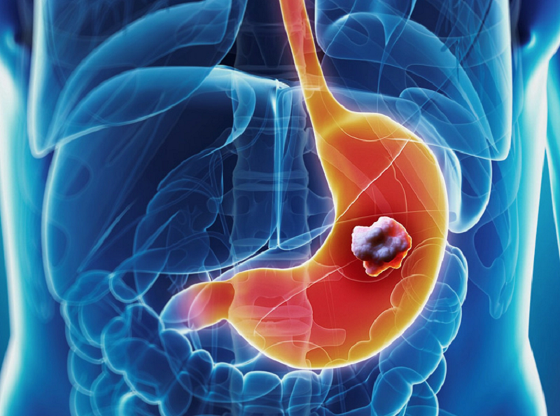 cắt dạ dày sống được bao lâu