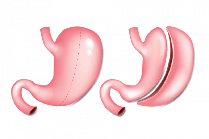 cắt dạ dày sống được bao lâu