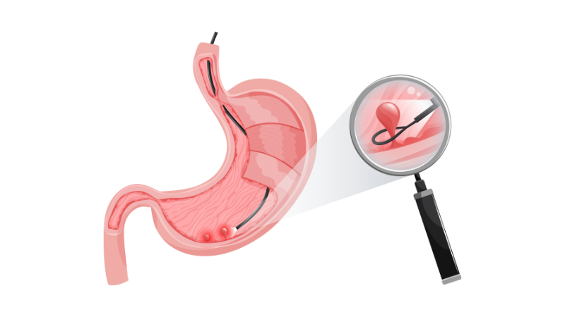 kết quả nội soi dạ dày