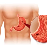 khám dạ dày không cần nội soi