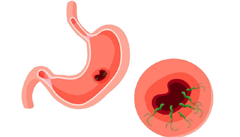 nguyên nhân gây ung thư dạ dày