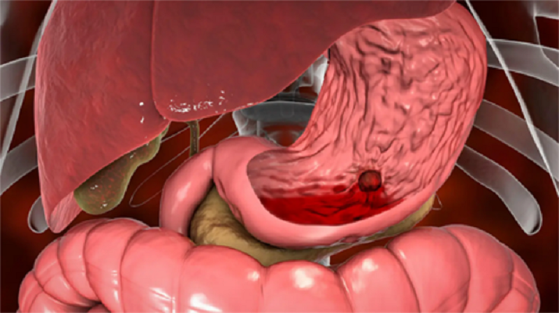 sốt xuất huyết dạ dày