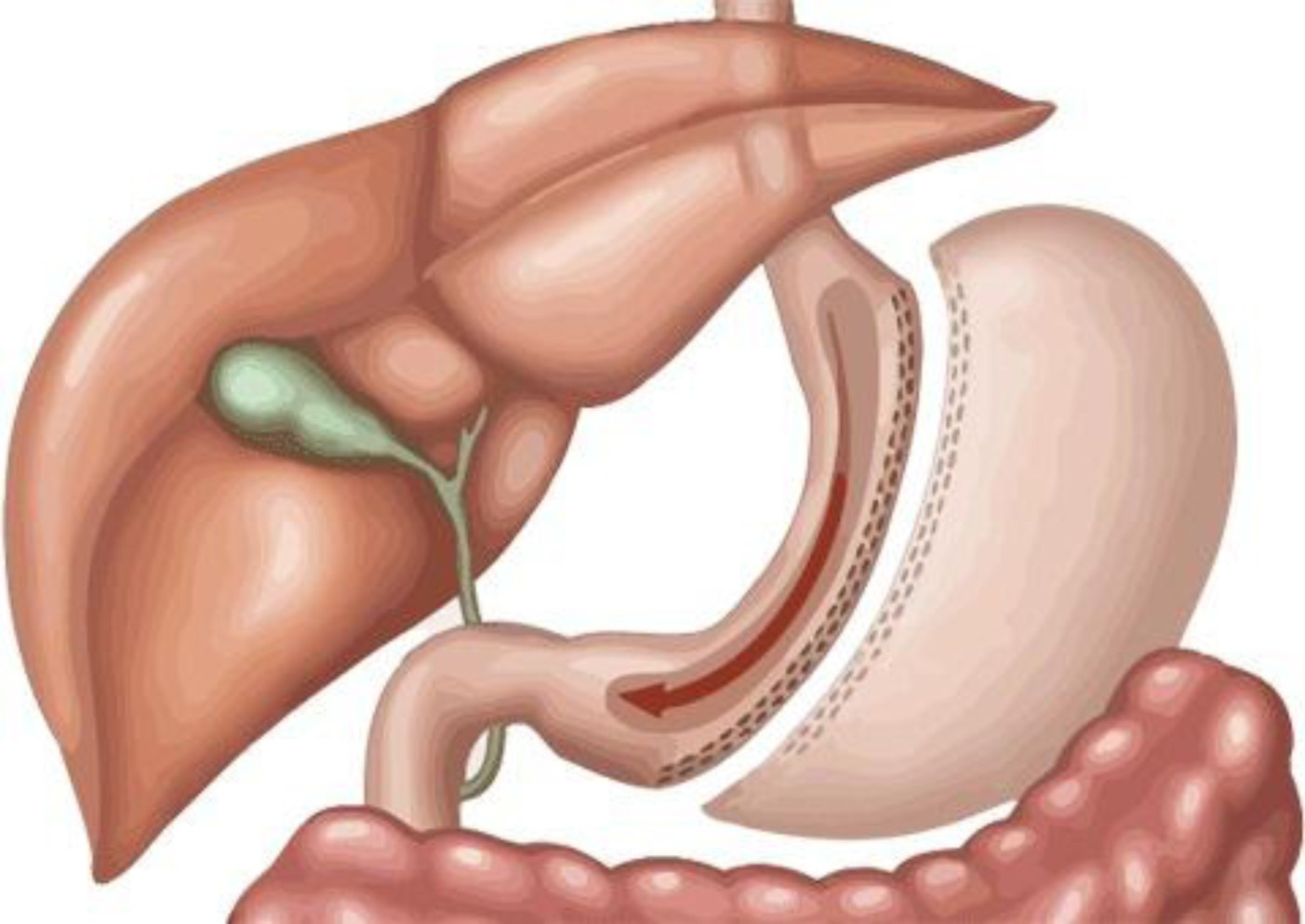 ung thư dạ dày có nên mổ không