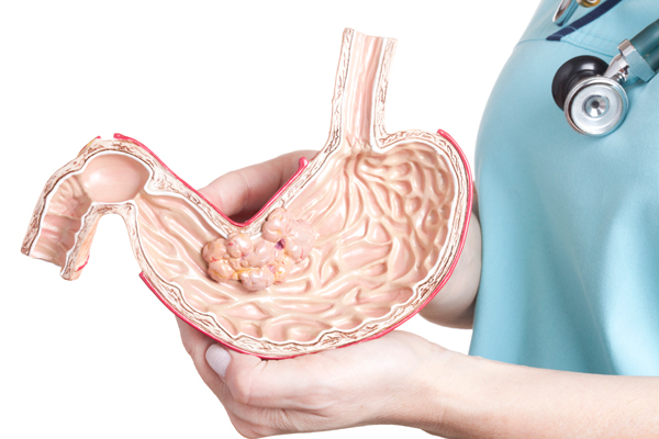 ung thư dạ dày có nên mổ không