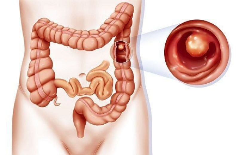 polyp đại tràng có nên cắt không