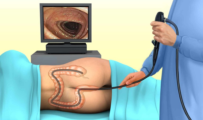 polyp đại tràng có nên cắt không