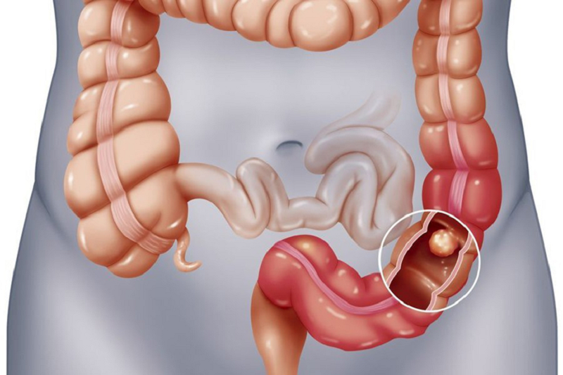 polyp đại tràng có nên cắt không