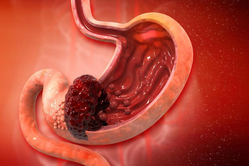 viêm teo niêm mạc dạ dày c3 là gì