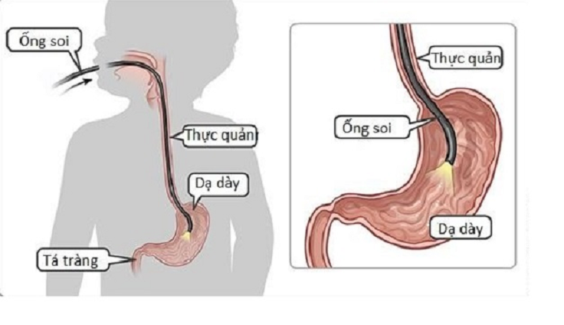 h pylori igm là gì